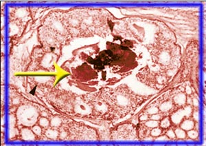 Breast Calcification