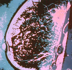 Mastitis