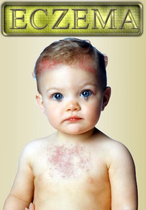 baby eczema