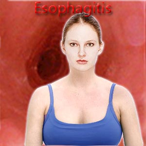 Esophagitis - Wikipedia, the free.