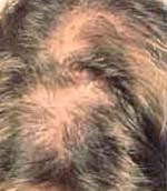 Hair Loss