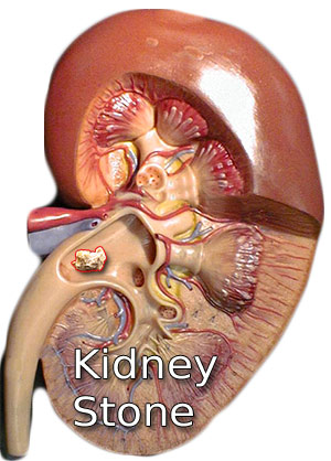 Kidney Stone