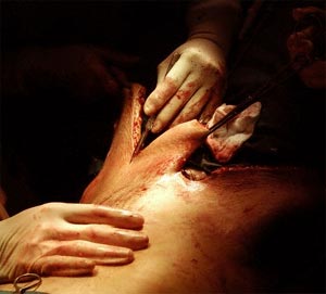 Liposuction Surgery