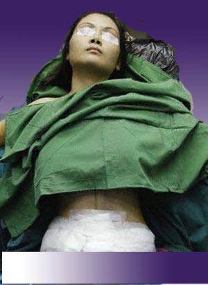 Midregion Liposuction Surgery