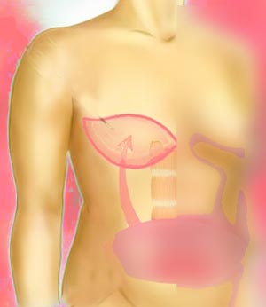 TRAM Flap Augmentation Mammoplasty
