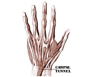 Carpal Tunnel Syndrome