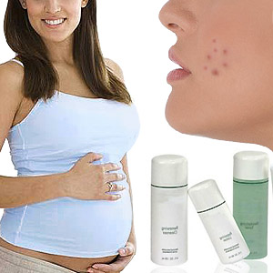 Acne during Pregnancy