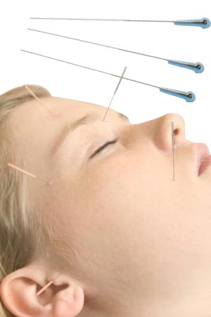 Acupuncture Point