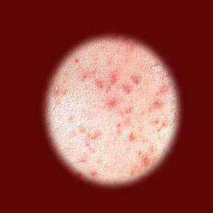 Adult Acne in Women