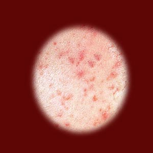 Adult Acne in Women