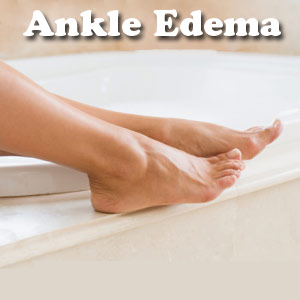 Ankle Edema