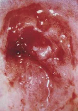 Uterine Cervix Cancer