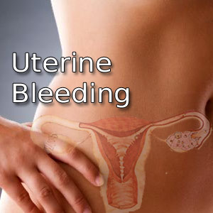 Dysfunctional Uterine Bleeding