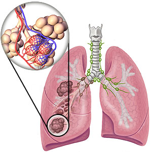 Emphysema Lung