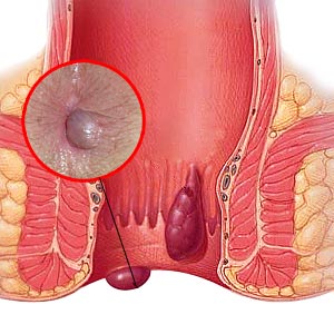 Hemorrhoids