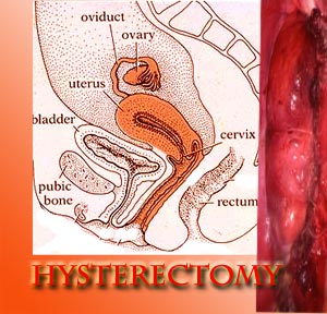 Hysterectomy