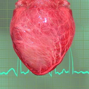 Ischemic Heart Disease