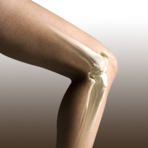 Knee Replacement for Women