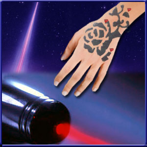 Laser Tattoo Removal