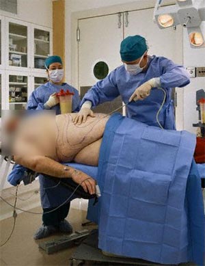 Liposuction operation