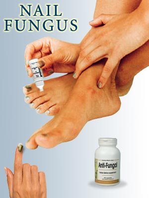 Nail Fungus