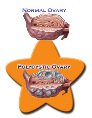 Polycystic Ovarian Syndrome