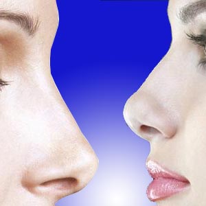 Rhinoplasty