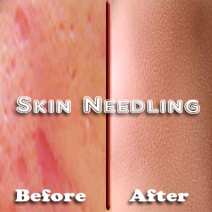 Skin Needling