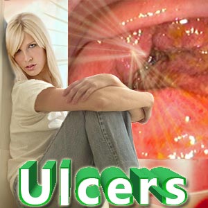 Causes of Stomach Ulcers