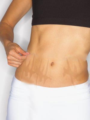 Laser Stretch Mark Removal