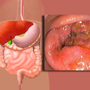 Ulcerative Colitis