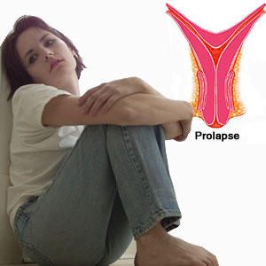 Uterine Prolapse