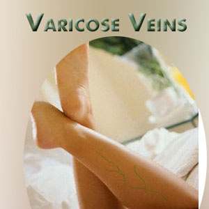 Varicose Veins